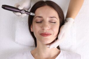 Microagulhamento Facial Tratamento Estético
