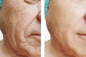 Tratamento para rugas