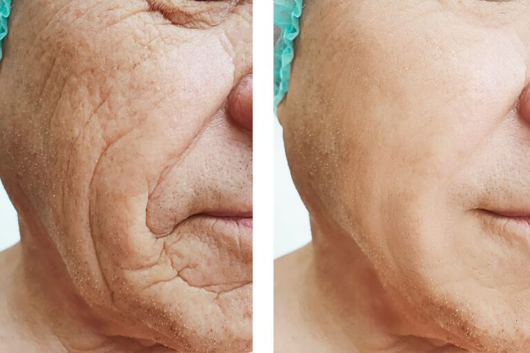 Tratamento para rugas