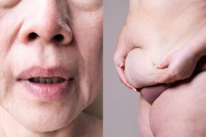 Flacidez Facial e Corporal